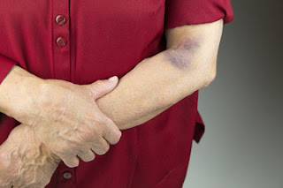 Ways to treat hematoma at home