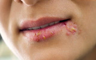 What-you-need-to-know-about-herpes