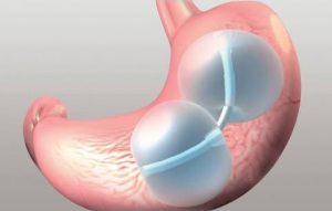 Reshape gastric balloon