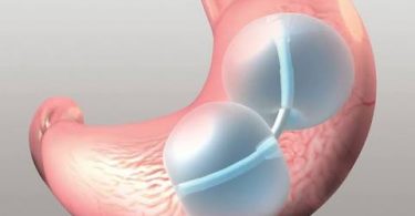 Reshape gastric balloon