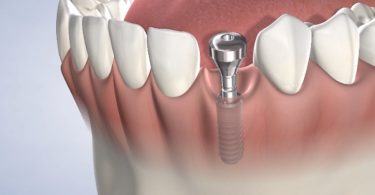 Why Consider Single Stage Dental Implants?