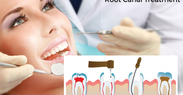 Root canal treatment