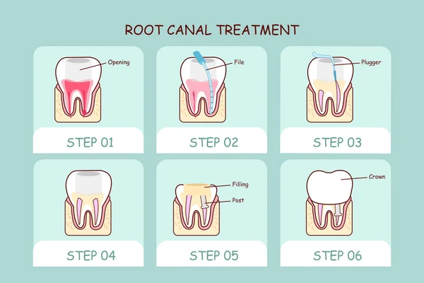 Root Canal Treatment