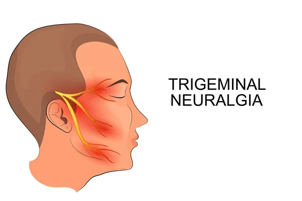 Facial Nerve Pain