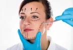 Overview of the Endoscopic Facelift Procedure